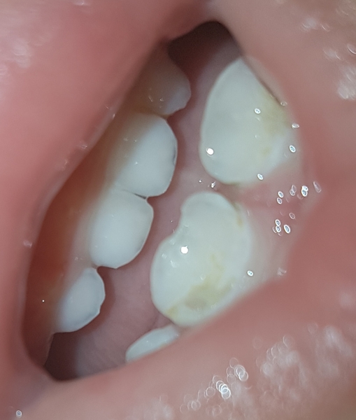 Dd 17 month old teeth