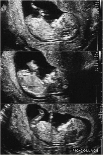 Boy or girl from 12 week scan - any guesses?