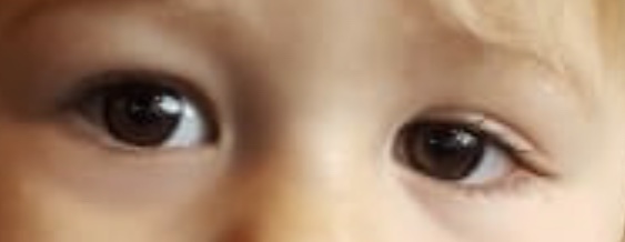 Congenital ptosis (droopy eyelid)