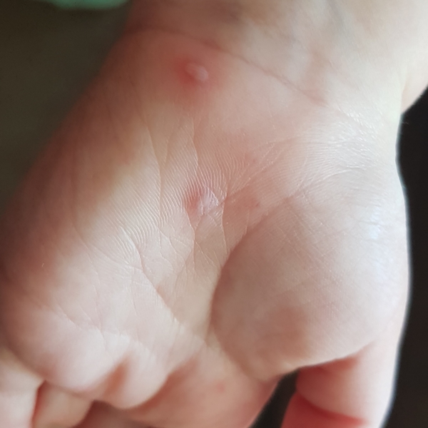 What's this on her hand?