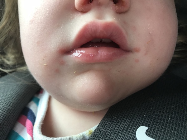 Could this be Hand foot and mouth?