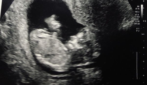 Any gender guesses? 12 week scan :)