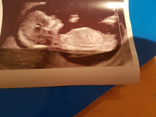 Boy or girl? 13 weeks