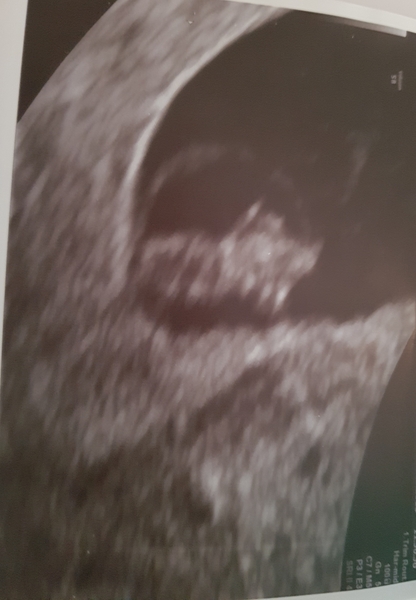 Pregnancy after loss: spring 2019 edition (The Brexit Babes) 🐧