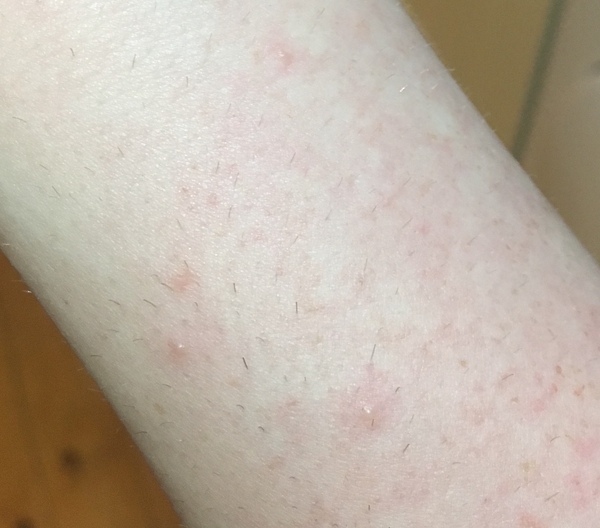 To ask you to help me work out what this rash is?
