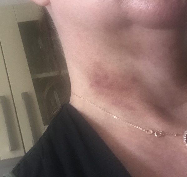Ultherapy?