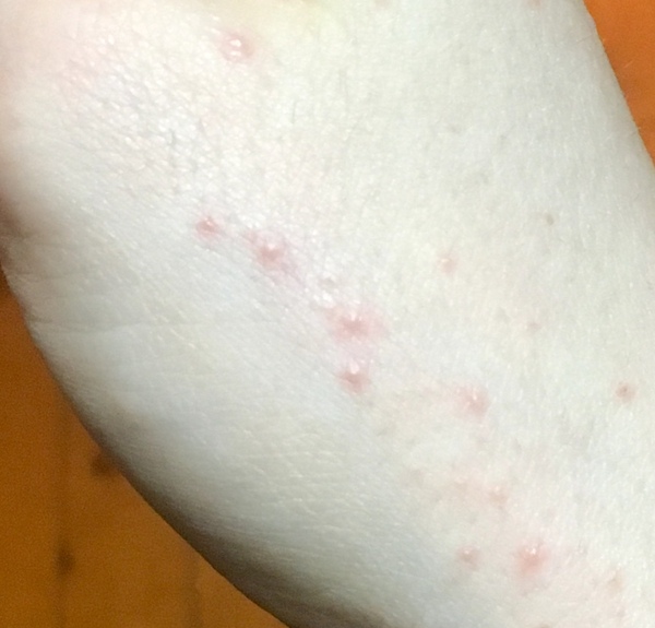 To ask you to help me work out what this rash is?