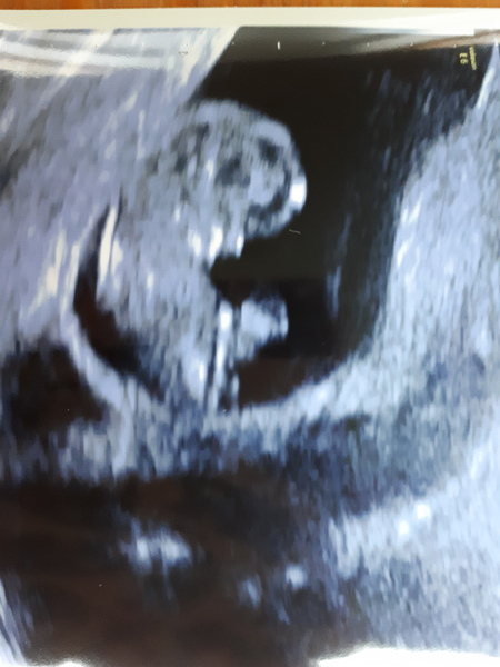 10 week scan