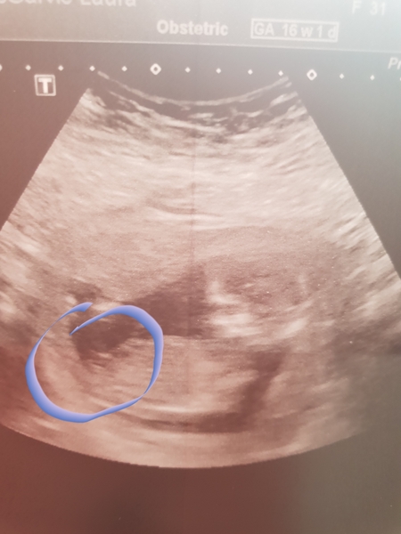 Is this the nub?