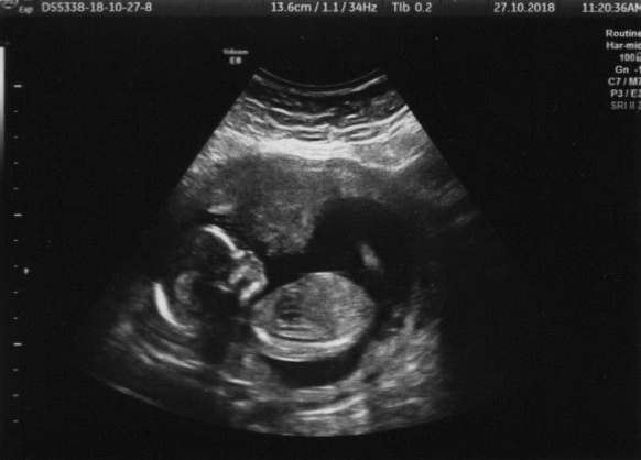 Boy or girl from 12 week scan - any guesses?