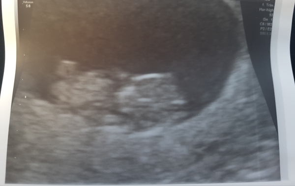 Pregnancy after loss: spring 2019 edition (The Brexit Babes) 🐧