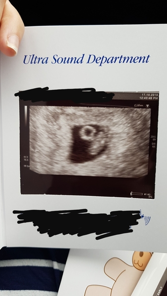 6 week scan