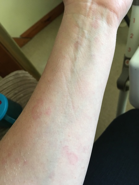 What’s this rash? *picture included*