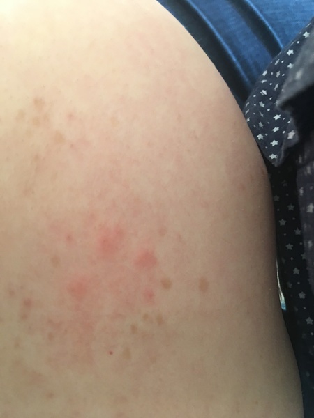 HFMD??? Picture included