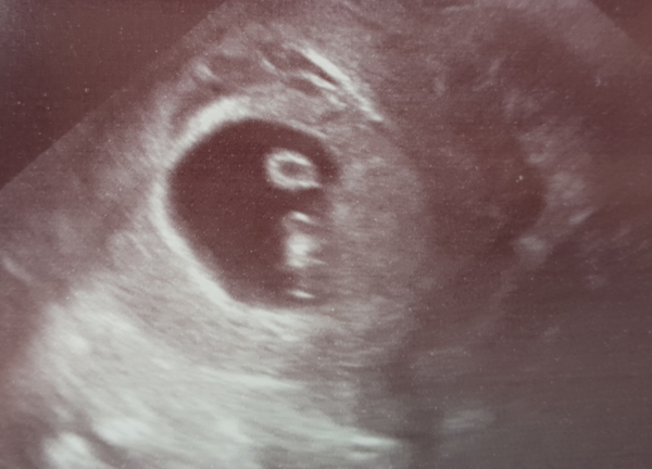 Advice on early 6 week scan