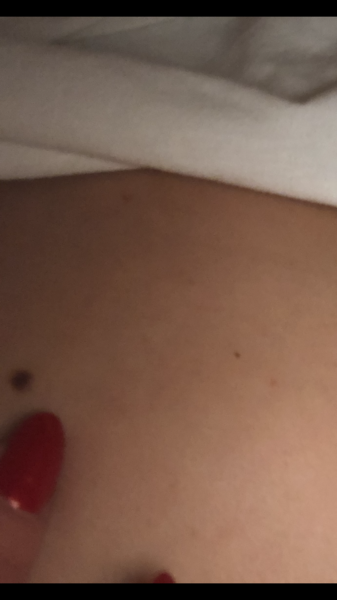 Mole on back
