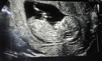 Any gender guesses? 12 week scan :)