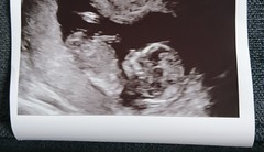 Awkward baby position - gender guesses!