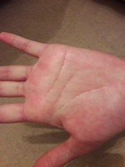 Scabies or allergic reaction?