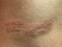 Shingles? (Pic included)
