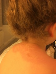 Itching!