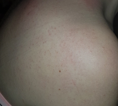 Does anyone know what this rash is? (See photo)