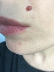 What is this line around my lips? Is it melasma?