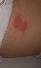 These are bed bug bites aren't they?