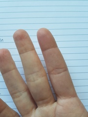 Stupid injury I'm slightly worried about