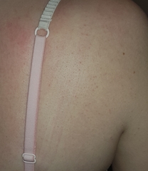 Does anyone know what this rash is? (See photo)