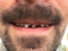 Tooth extraction and immediate denture?