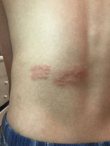 Shingles? (Pic included)