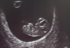 Boy or girl 9 week scan??