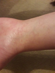 Scabies or allergic reaction?