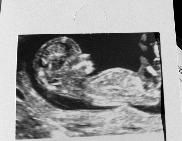 Gender guesses on NT scan? (12 + 5) - just for fun :)