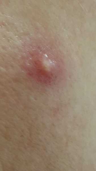 One random, highly visible, Vesuvius-like ZIT