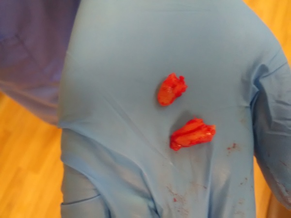 Old infected root extraction... Interested?