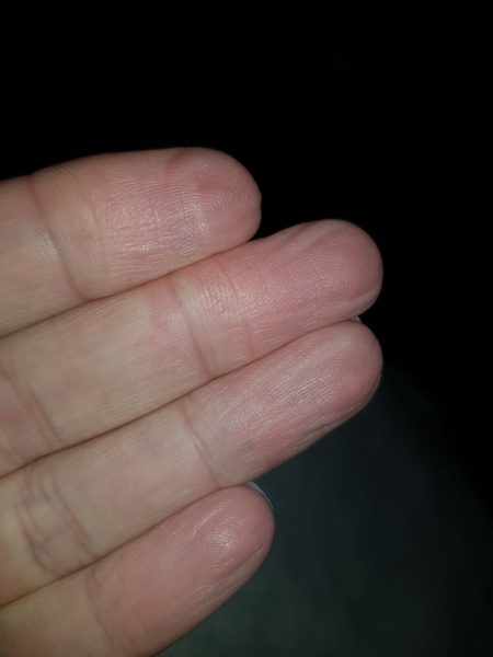 What the hell is going on with my finger tips (photo)