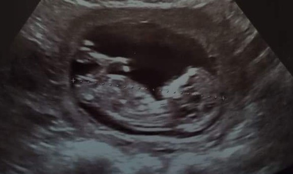 Nub theory - what does my baby look like to you?