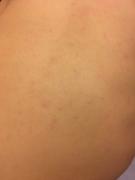Spots....viral? Allergy?
