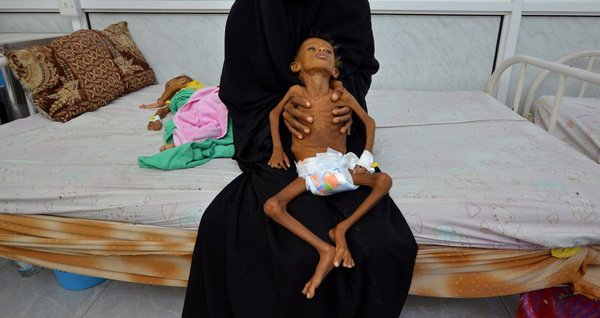 Children are dying of hunger in Yemen right now