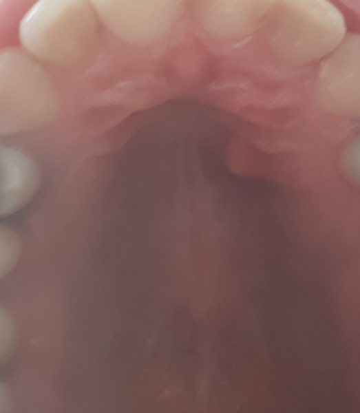 Lump in my mouth. Need help!