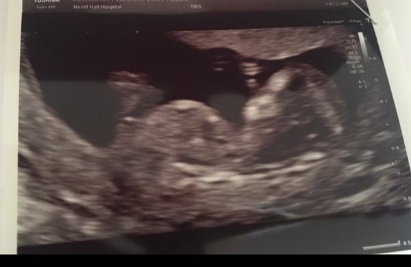 Dating scan next week - anyone else?