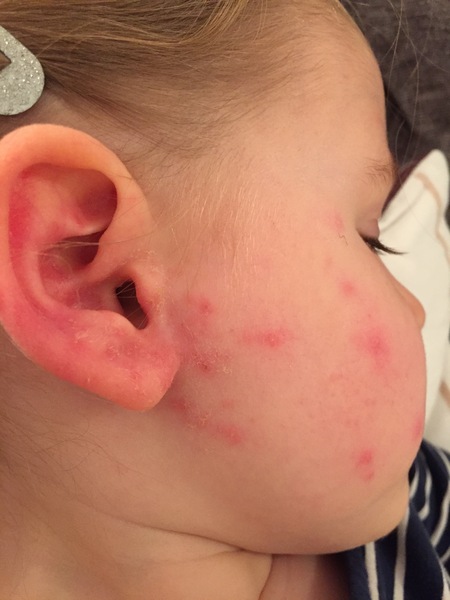 To ask if this is chickenpox?