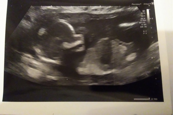 Boy or girl?