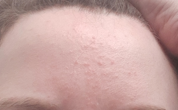 What the hell is wrong with my forehead?