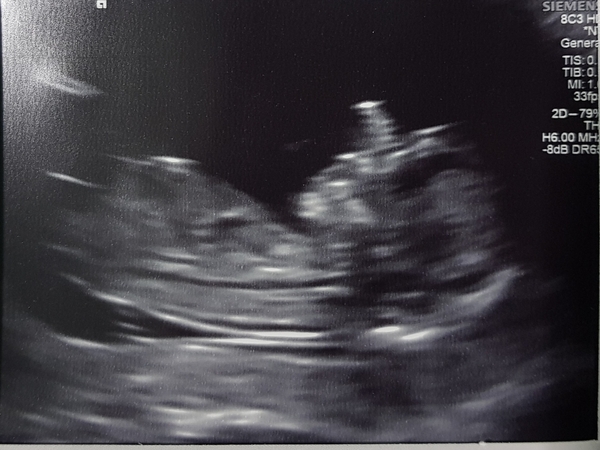 Dating scan next week - anyone else?