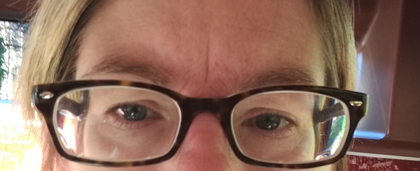 I had botox today!