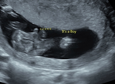 16+6w gender scan- do you agree?