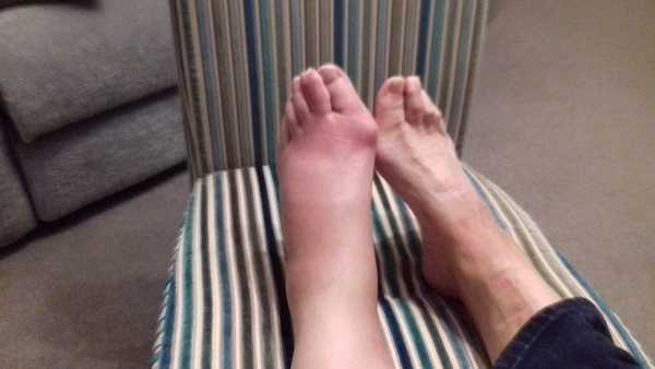 Would you go to a @ e if this was your foot?